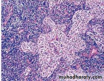 Pathology of lymph nodes