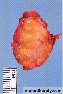 Reactive hyperplasia