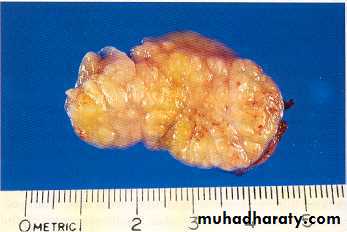 Reactive hyperplasia
