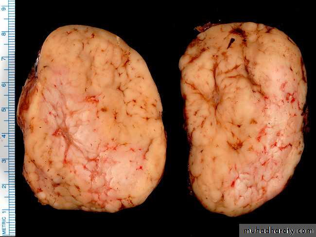 Reactive hyperplasia