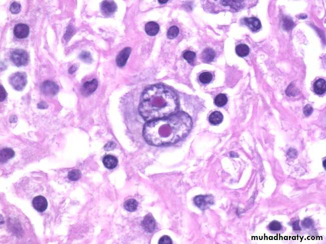 Reactive hyperplasia