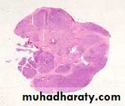 Reactive hyperplasia
