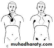 Reactive hyperplasia