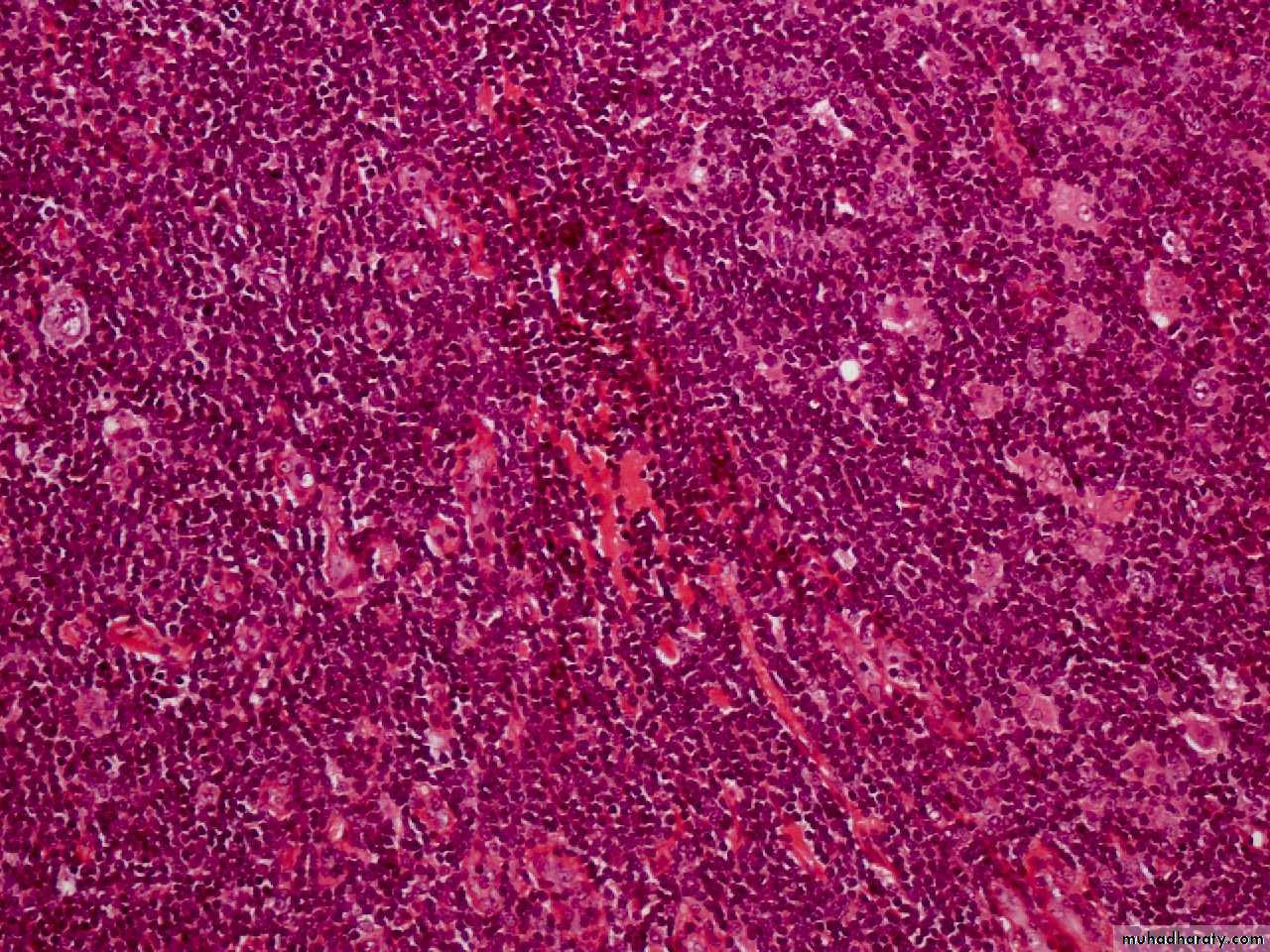Reactive hyperplasia