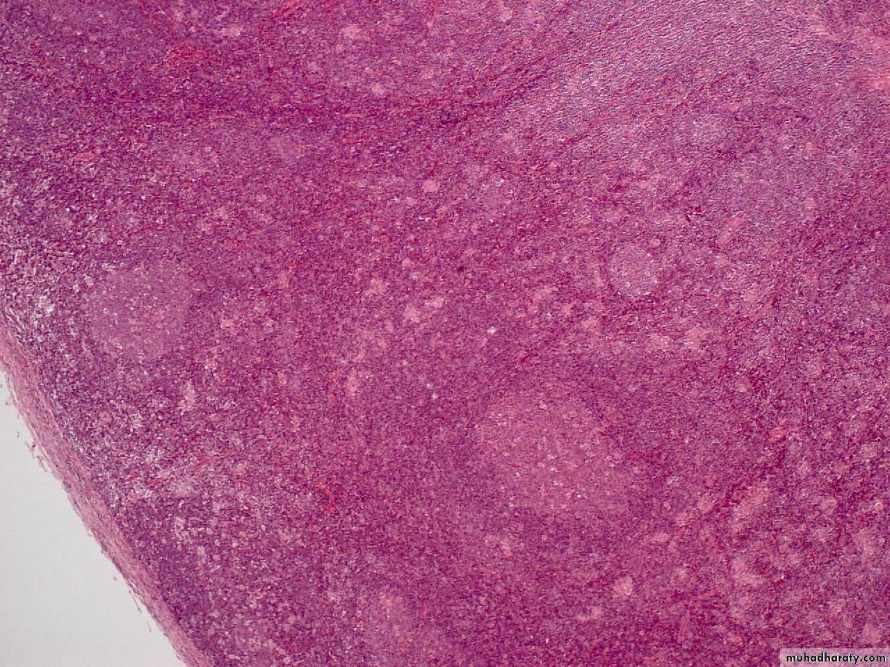 Reactive hyperplasia