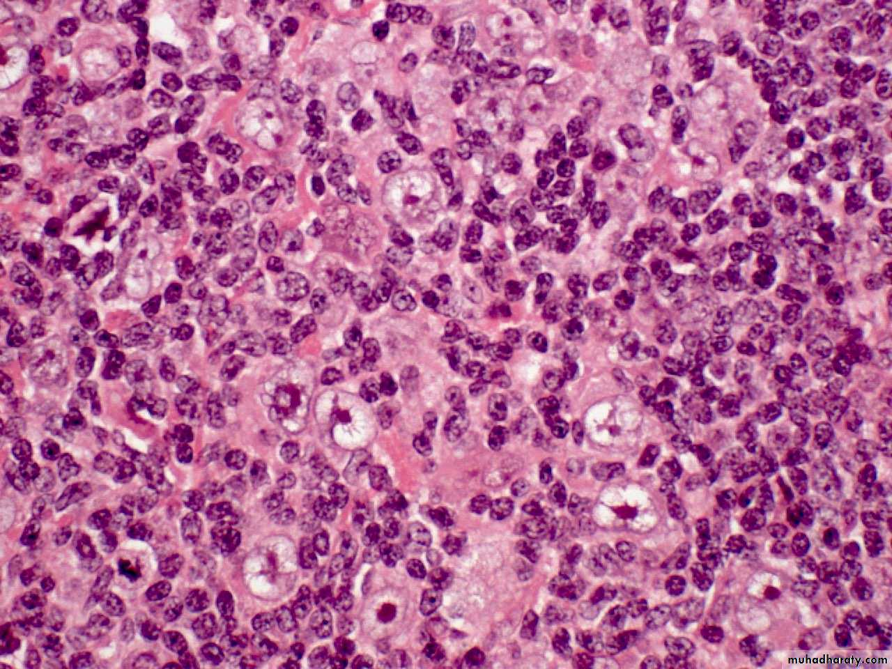 Reactive hyperplasia