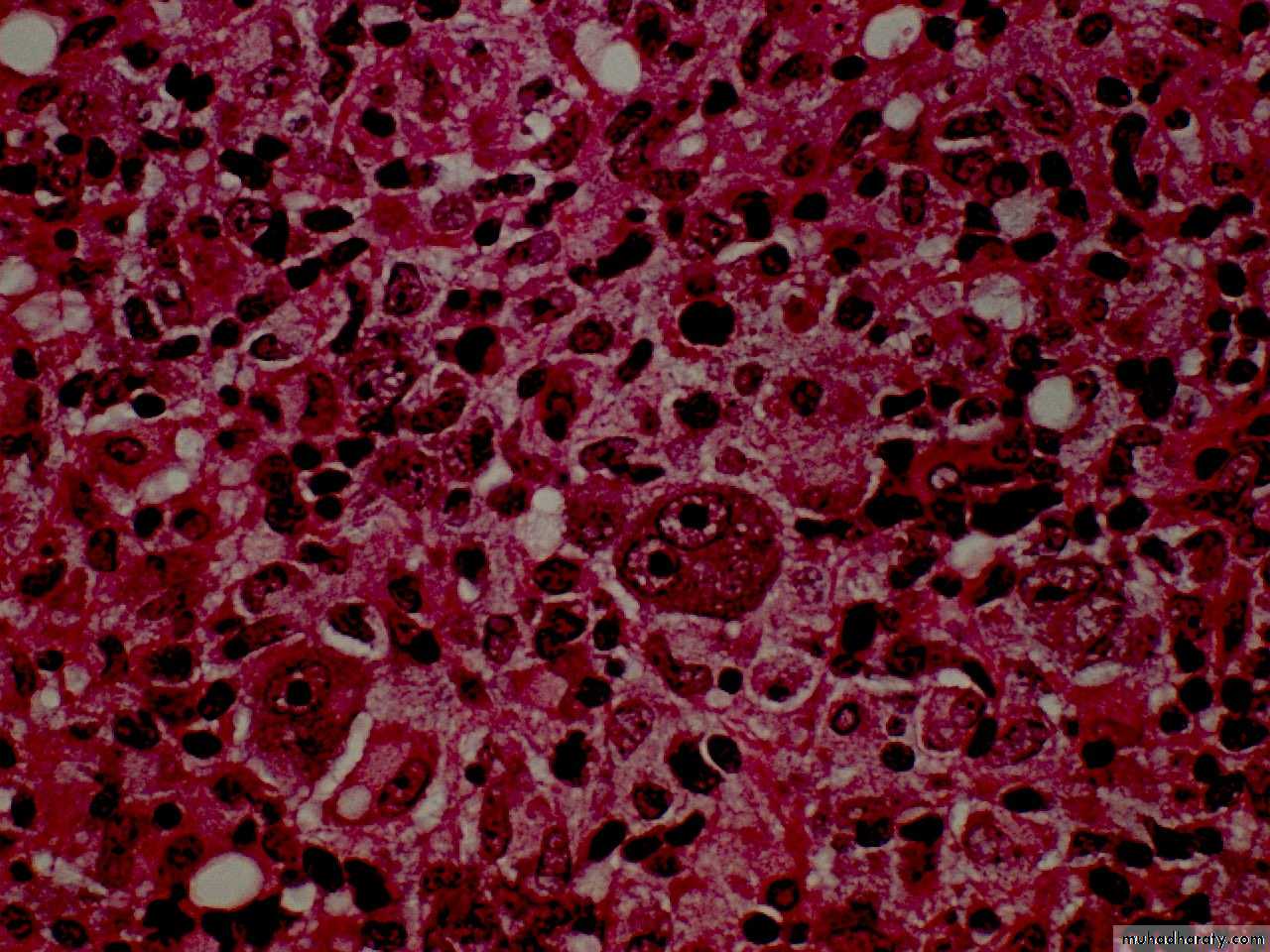 Reactive hyperplasia