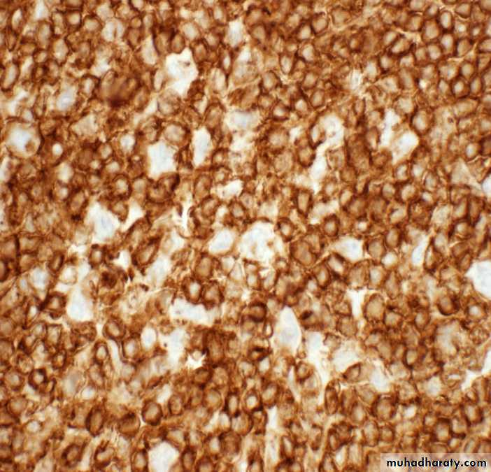 Reactive hyperplasia