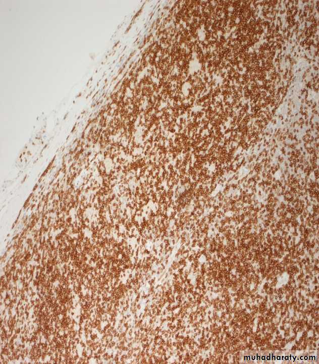 Reactive hyperplasia