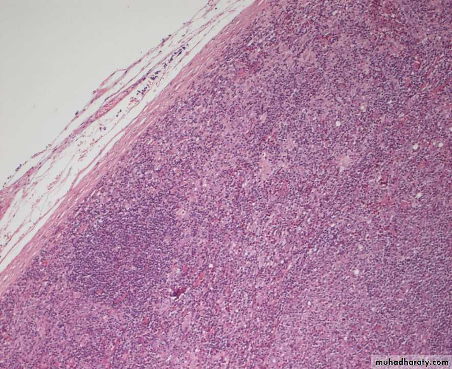 Reactive hyperplasia