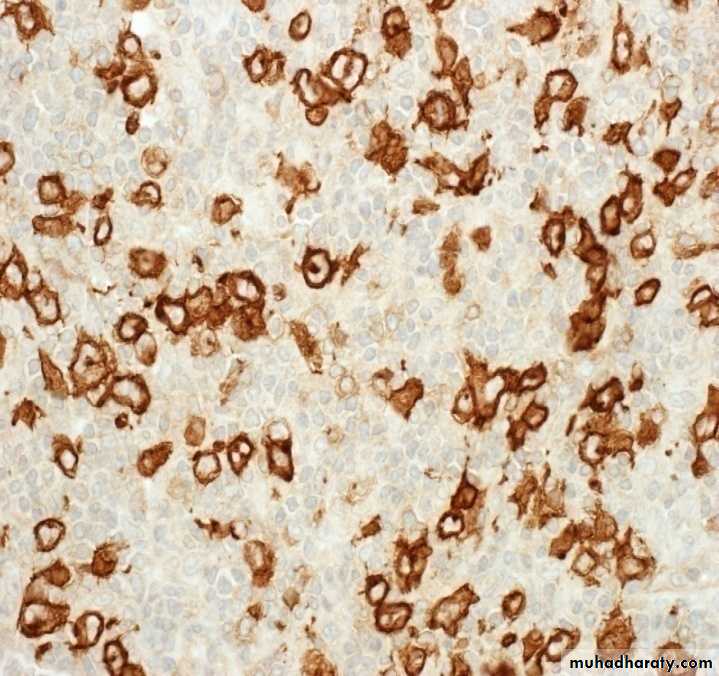 Reactive hyperplasia