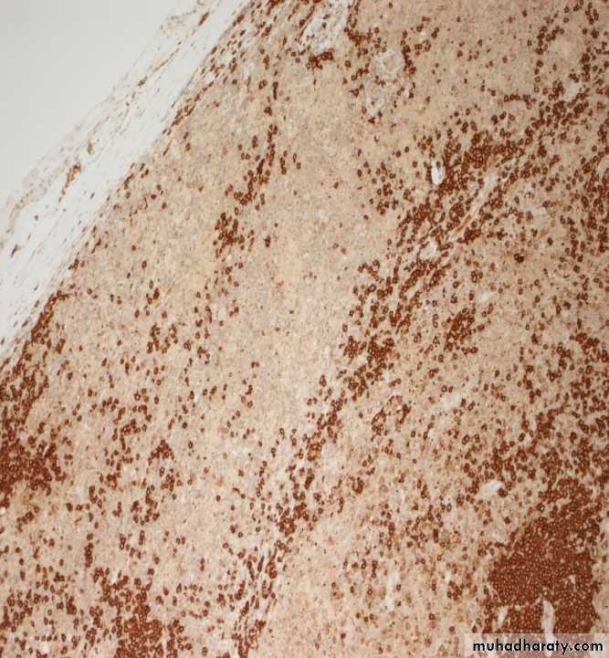 Reactive hyperplasia