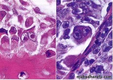 Reactive hyperplasia