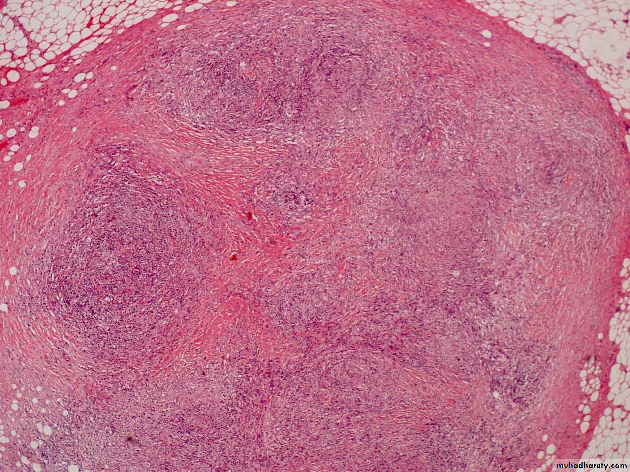 Reactive hyperplasia