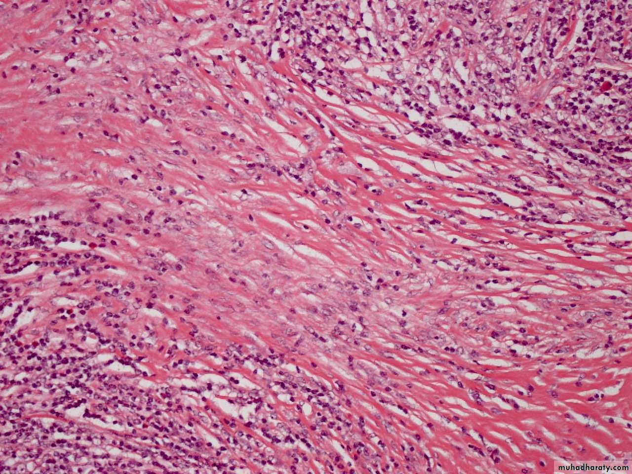 Reactive hyperplasia