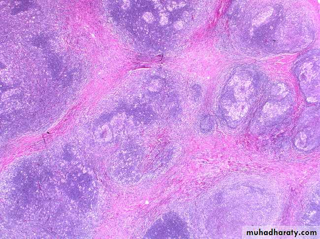 Reactive hyperplasia