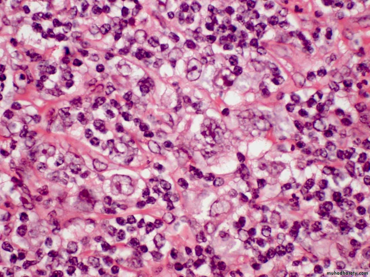 Reactive hyperplasia