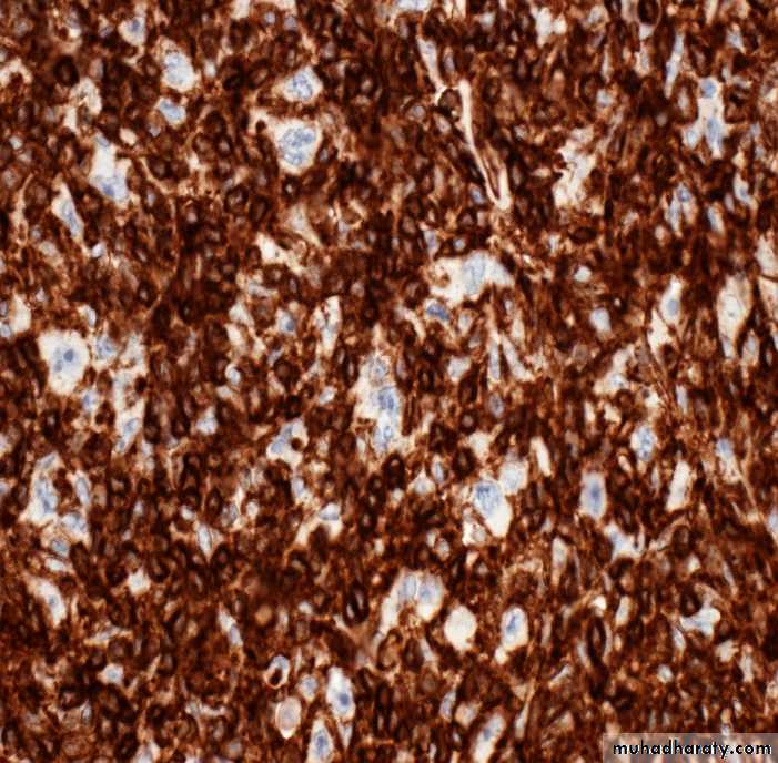 Reactive hyperplasia