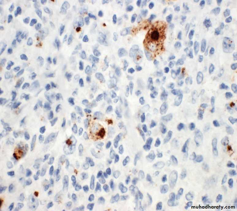 Reactive hyperplasia