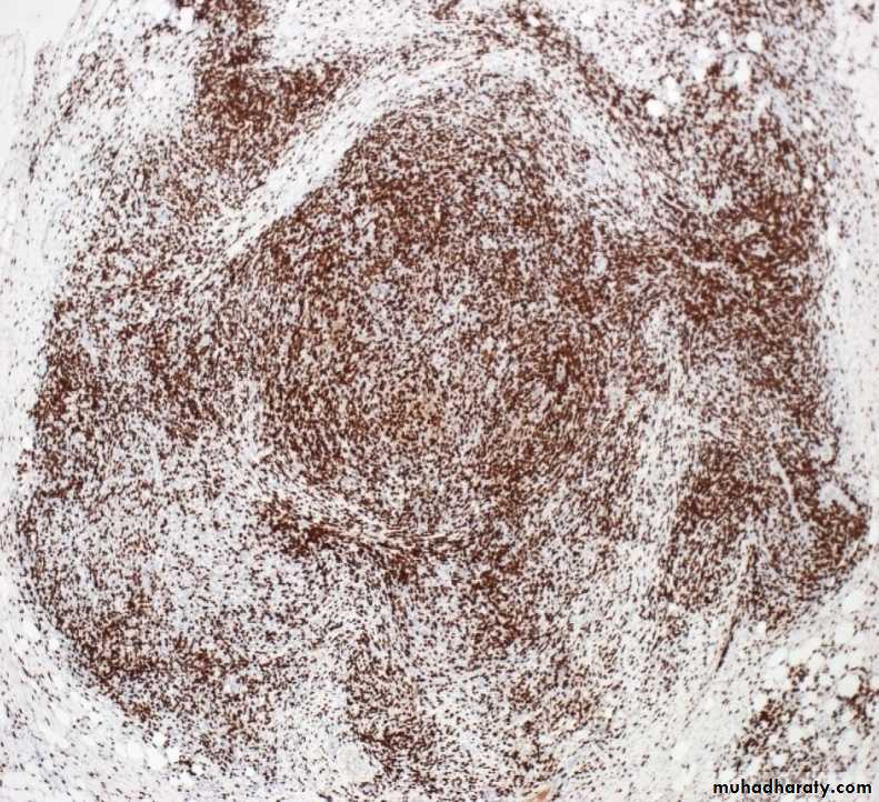 Reactive hyperplasia