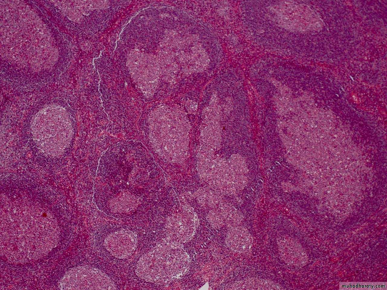 Reactive hyperplasia
