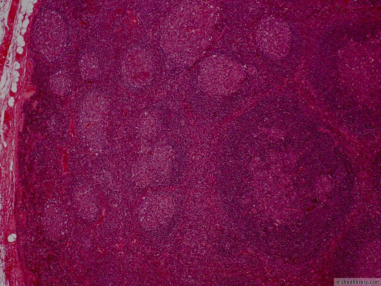 Reactive hyperplasia