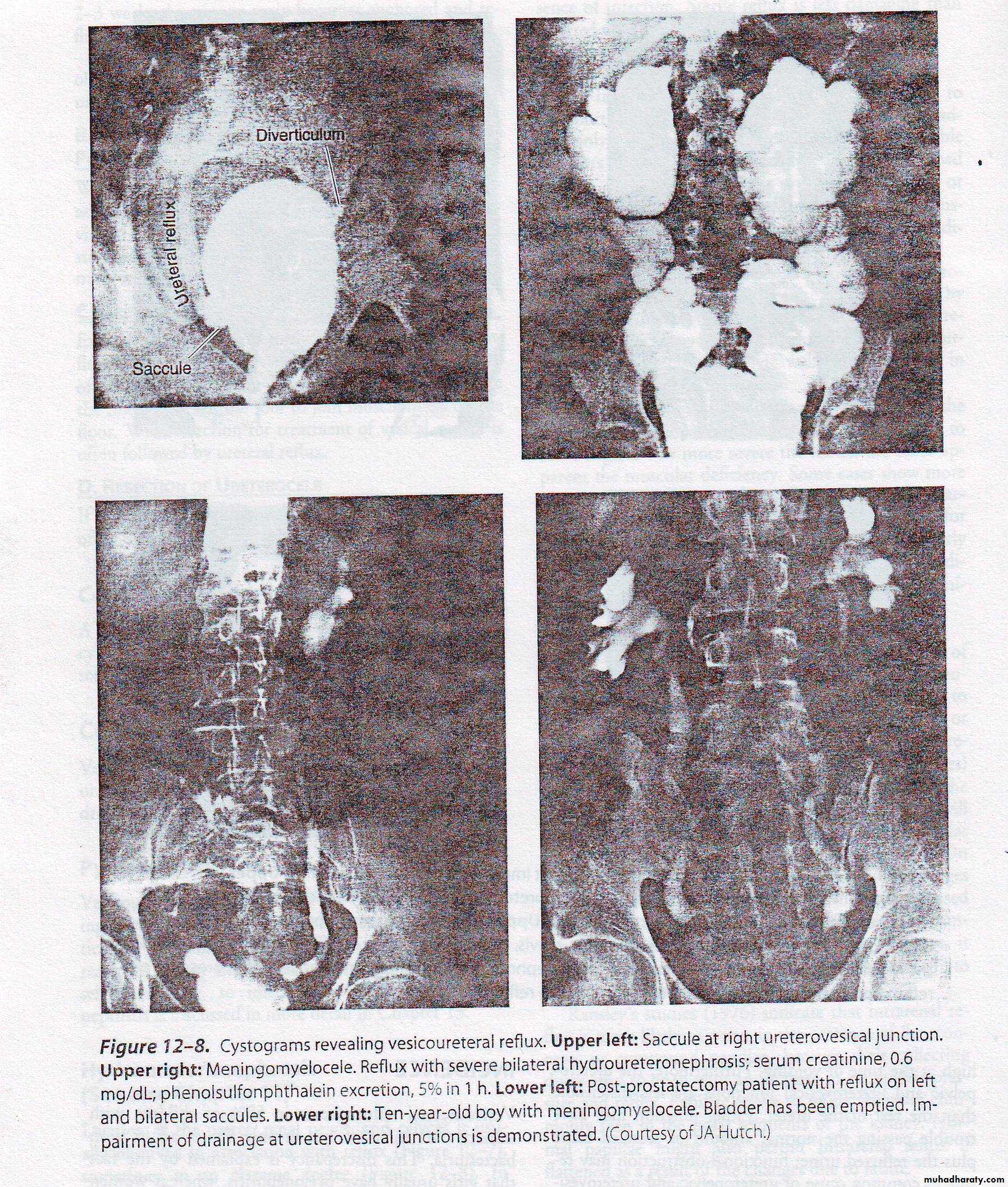 Vesicoureteral reflux