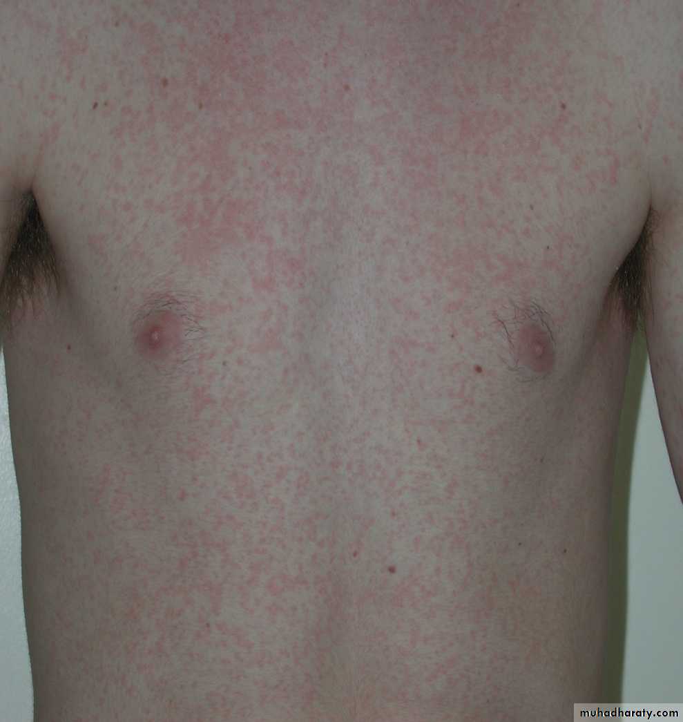 AIDS - HIV