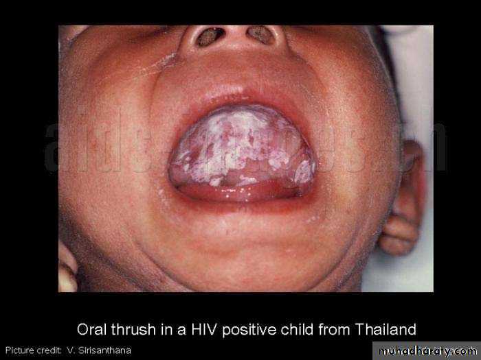 AIDS - HIV