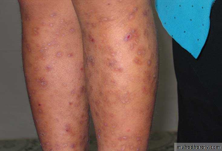 AIDS - HIV