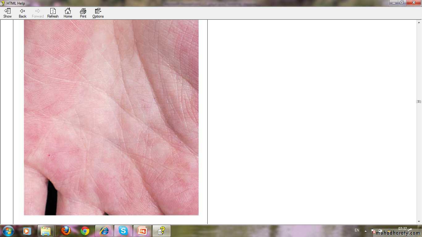 Manifestations of Systemic Diseases