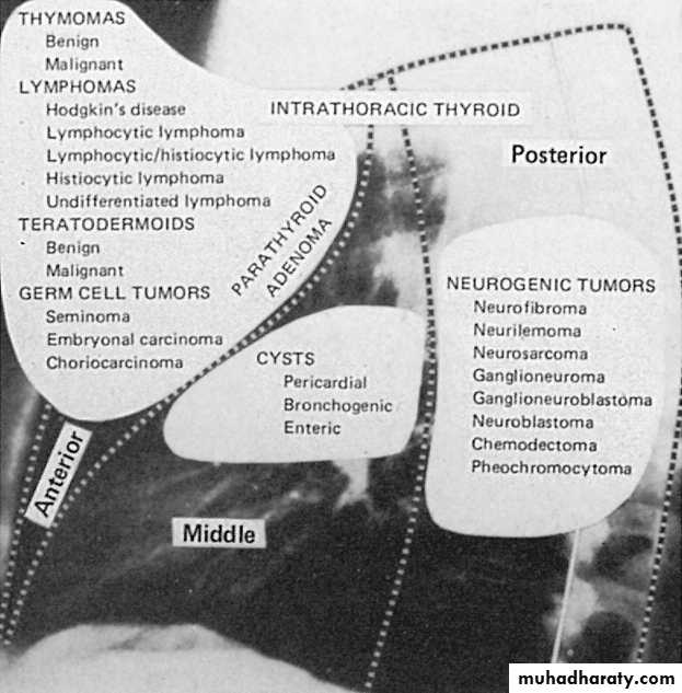 Bronchiectasis