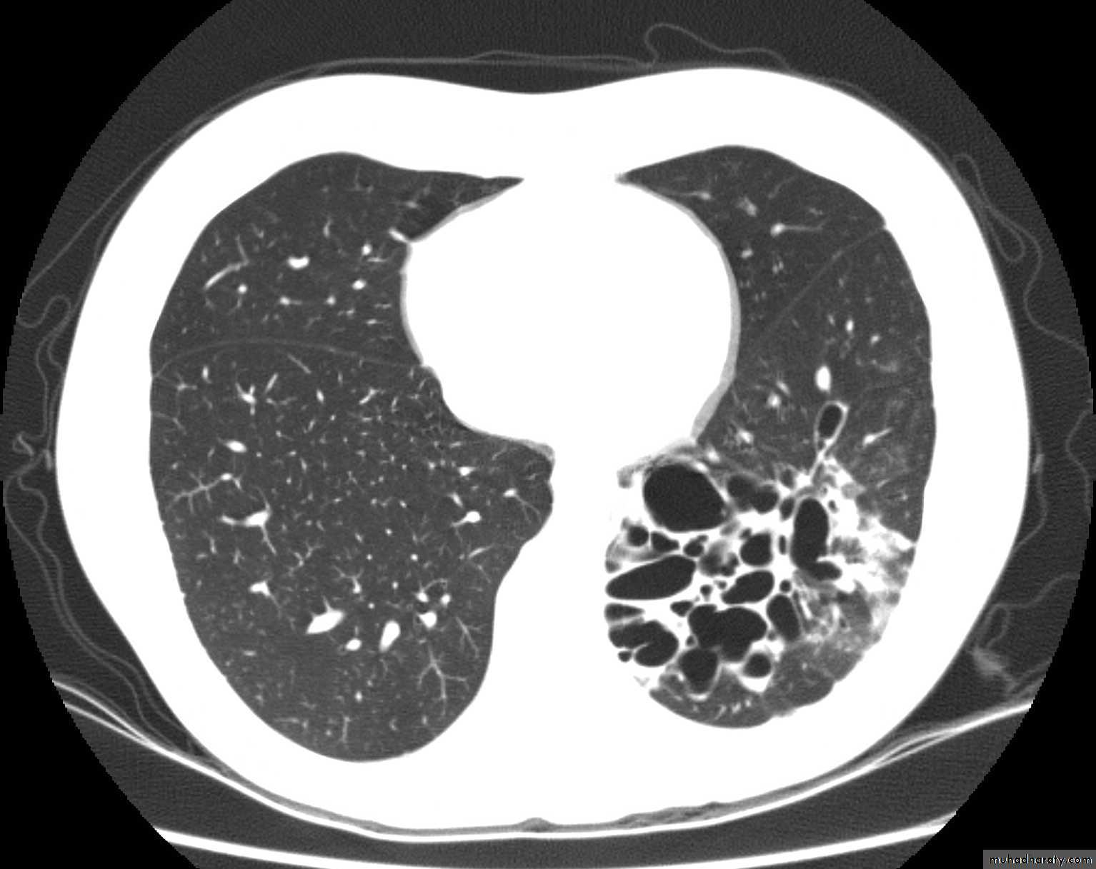 Bronchiectasis