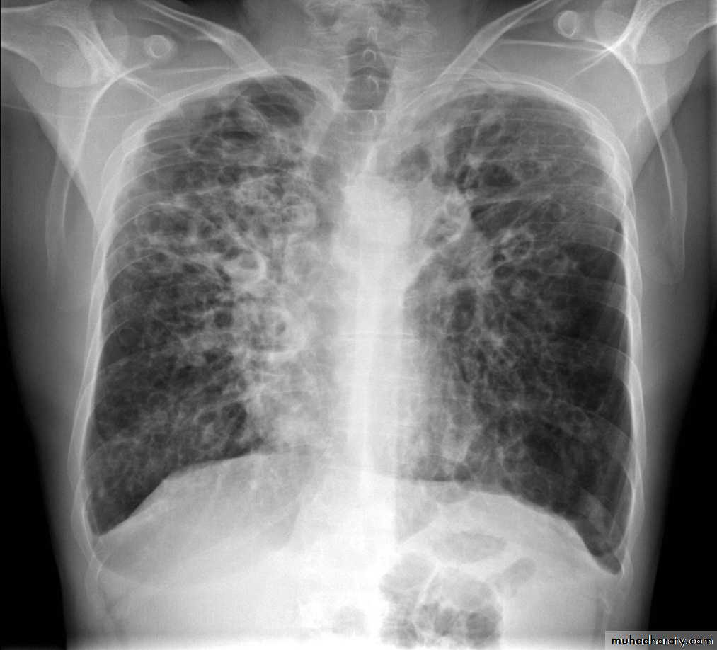 Bronchiectasis