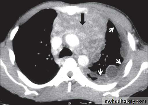 Bronchiectasis