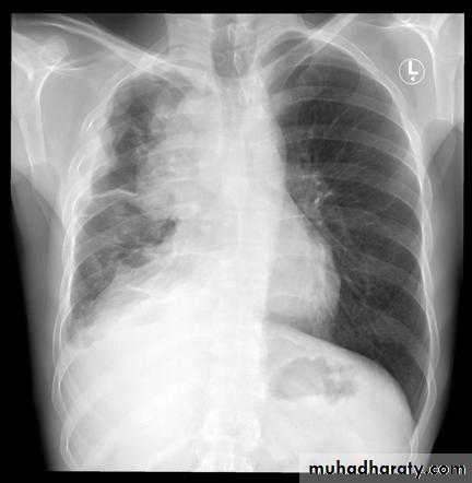 Bronchiectasis