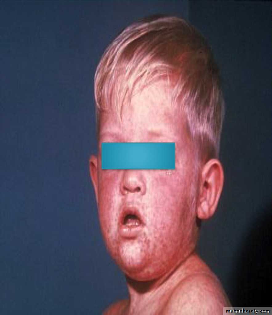 Paramyxoviruses