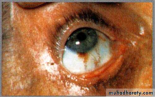 Infective endocarditis
