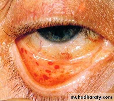 Infective endocarditis