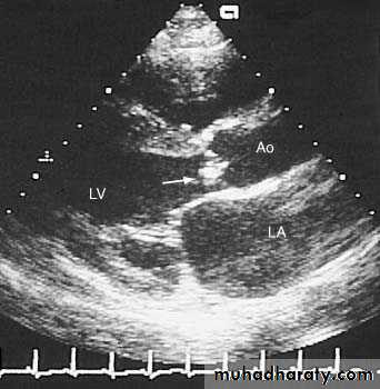 Infective endocarditis