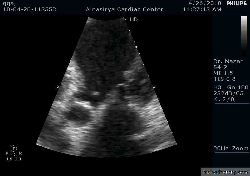 Infective endocarditis