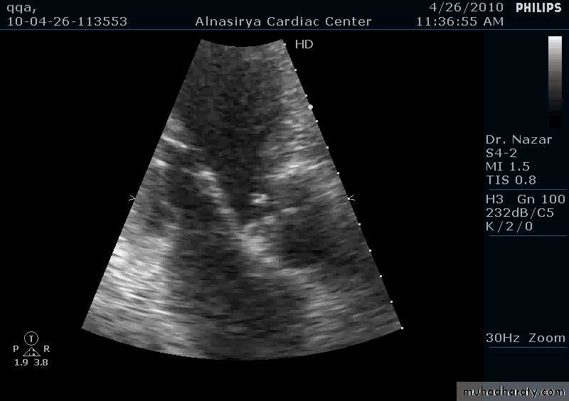 Infective endocarditis