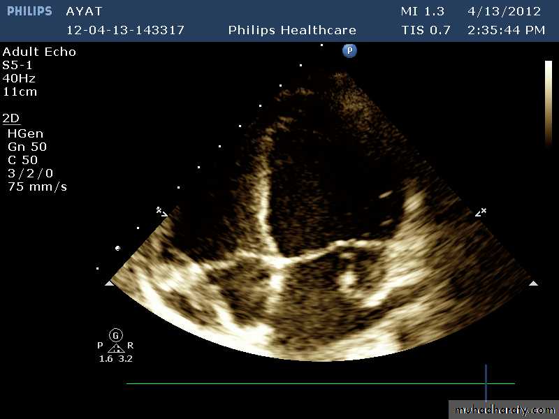 Infective endocarditis