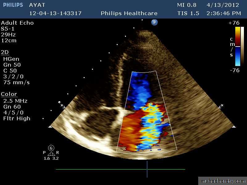 Infective endocarditis