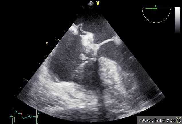 Infective endocarditis