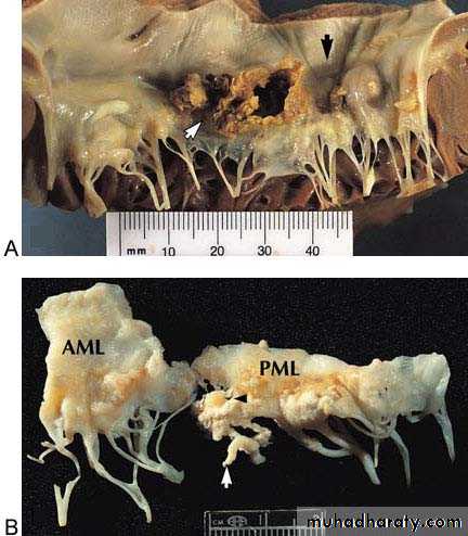 Infective endocarditis
