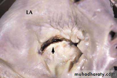 Infective endocarditis