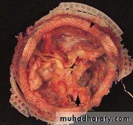 Infective endocarditis