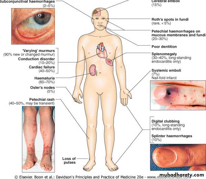 Infective endocarditis