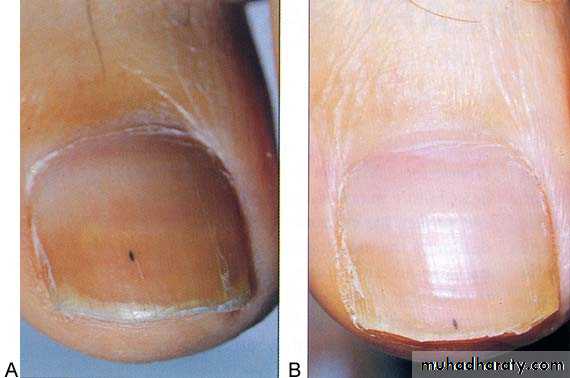 Infective endocarditis